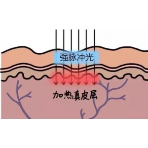 合肥光子嫩肤哪家医院好？2025年合肥光子嫩肤医院医生价格全解析