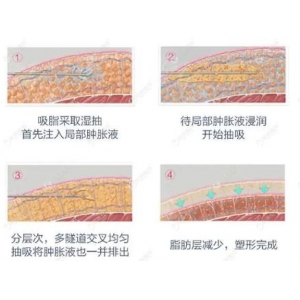 无锡施尔美整形医院怎么样?好评医生介绍、吸脂案例反馈!