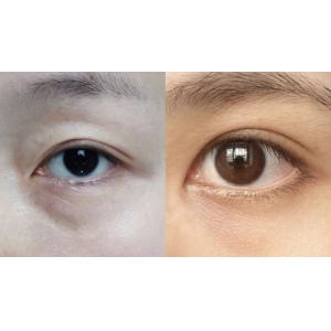 大连自体脂肪祛泪沟医生排名更新,这几位技术好效果自然