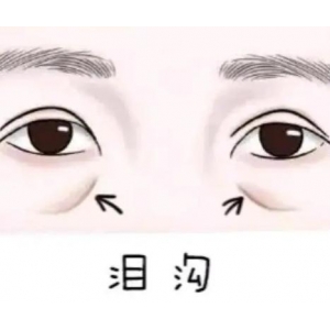 石家庄割眼袋手术费用明细解析,本地口碑整形医院前3强专业推荐