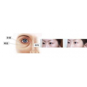 郑州铭艺医疗美容：玻尿酸祛泪沟效果能维持多久？注射层次很关键
