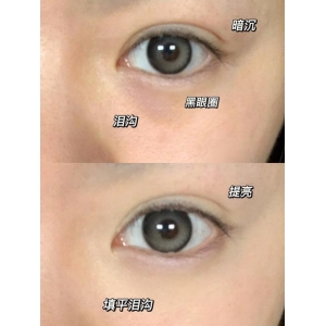 洛阳玻尿酸填充泪沟多少钱?2025最新价格表及医院推荐