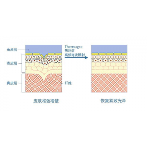 半岛超声炮和热玛吉哪个好？区别有哪些？