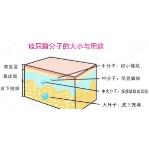 贝拉玻尿酸怎么辨别真假？注射玻尿酸以后要注意什么