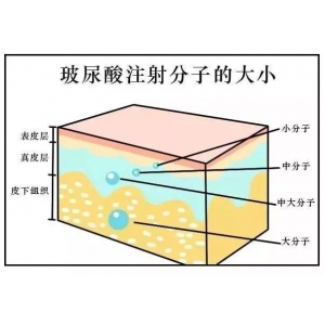 无锡玻尿酸祛法令纹哪家医院靠谱？施尔美、坤如玛丽、丽都等实力机构盘点