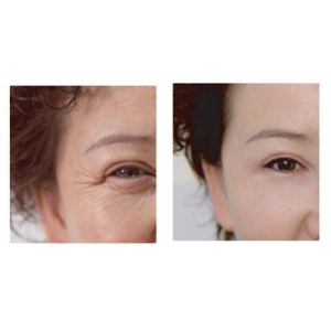 佛山华美联城抗衰除皱怎么样？玻尿酸注射自然皮肤管理专业