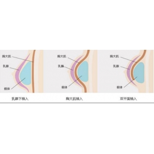 上海假体隆胸哪家医院好？最新排名与价格表全解析