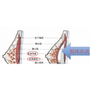 重庆玺悦台蒋福明医生做隆胸效果如何？价格大概是多少？