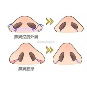 超肋鼻30000是不是贵了呢？超肋骨隆鼻手术的优点到底有哪些呢？