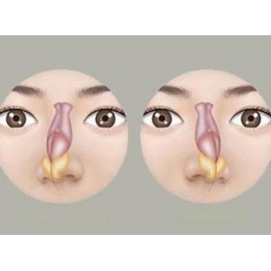赵柏程鼻部整形怎么样？附上鼻综合案例+价格