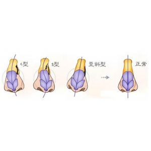常州曙光美容隆鼻怎么样?鼻部整形技术精湛价格公道附口碑评价