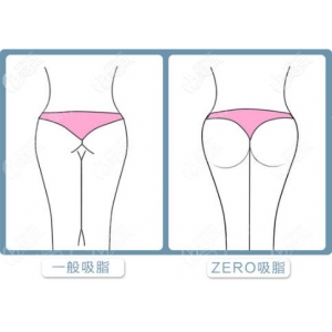 北海面部吸脂哪家好？红榜医院热门前四汇总