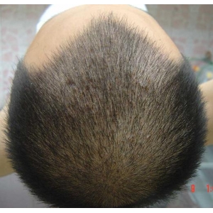 天津眉毛种植费用是多少?植眉优质医院价格一览