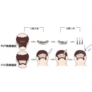 2025年成都植发哪家强?熙朵植发口碑与技术价格一览