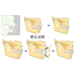 牙齿有一点点歪需要什么矫正，牙齿纠正前后对比图片