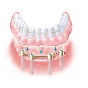 上海牙齿种植哪些医院靠谱？专业技术与口碑实力大盘点