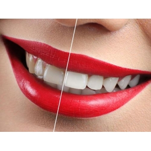 宁波牙齿种植哪家医院好?陈伟仕、徐斌、甘红实力推荐!