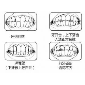 自锁托槽金属和陶瓷哪个好？自锁托槽牙齿矫正器要学会护理