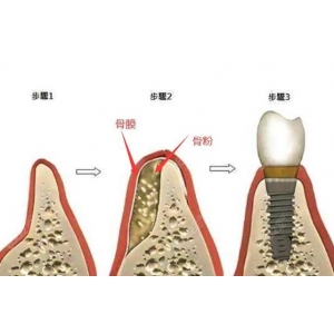 种牙跟拔牙比哪个疼？本篇内容给大家分析分析！