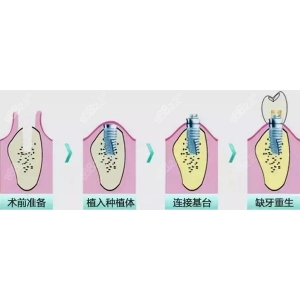 种植牙不到一年就坏了怎么办？种植牙价格&术后注意事项