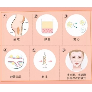 北京自体脂肪填充隆胸的感觉真的是鼓起勇气做这个手术！