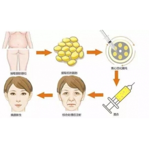 自体脂肪填充法令纹价格多少？风险大吗？相关咨询科普