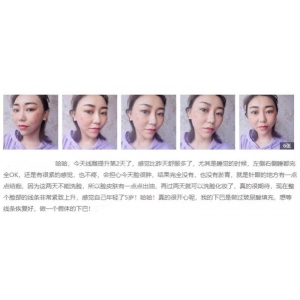 北京东方和谐冯斌怎么样？做面部填充的真实效果好不好