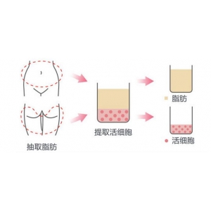 青岛华韩整形医院自体脂肪填充技术怎么样？真实案例+医生技术解析
