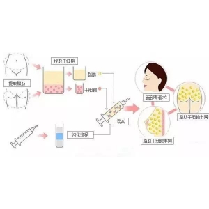 北京知音张立彬做脂肪填充多少钱？做面部填充、胸部填充效果都不错