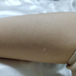 郑州惠美李金海医生详细简介来啦~内附脱毛价格明细~