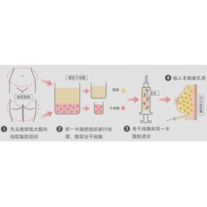 福州自体脂肪丰卧蚕哪家医院好？五家实力机构深度解析