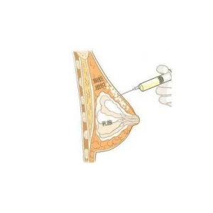 上海优仕美地巨富里医院自体脂肪祛泪沟能维持多久？技术优势解析！