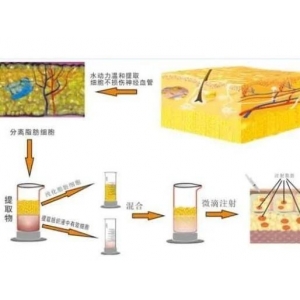 宁波自体脂肪丰鼻基底正规医院排名，这几家值得收藏！