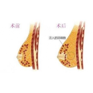 佛山自体脂肪填充哪家医院好？二院、曙光金子、华美联城等用户反馈不错~