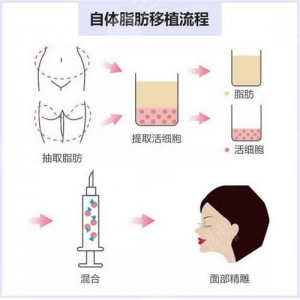 武汉自体脂肪隆胸哪家整形医院好？自体脂肪隆胸大概多少钱？