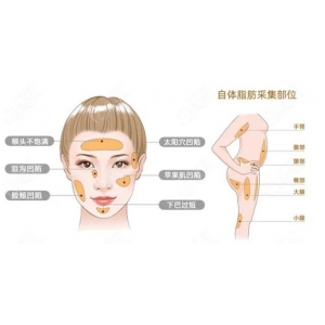 济南自体脂肪隆胸适合人群有哪些？做隆胸权威医生有哪些