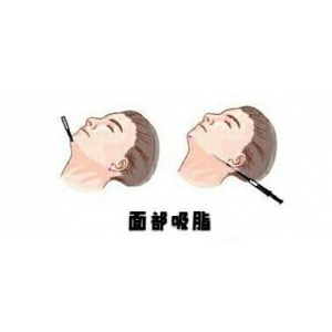 西安艺星医疗美容医院紧致轮廓需要多少钱？专家团队、价格明细