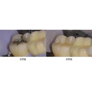 菏泽洗牙多少钱快速？2026年菏泽市洗牙价格表及高性价比口腔医院推荐！