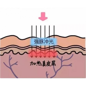 金华义乌欧莱美医疗美容医院光子嫩肤效果好吗？专业医生团队打造透亮肌肤