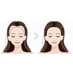 沈阳美人尖种植哪家强？百嘉丽、杏林等5家植发医院技术对比