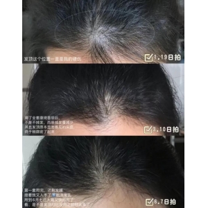 长沙协雅医疗发际线种植技术怎么样？专业医生与价格全解析