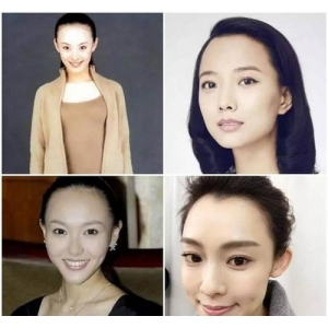 北京花皇医疗美容诊所正规吗？东城区老牌医美机构，专注眼部整形与自体脂肪移植二十年获赞誉！