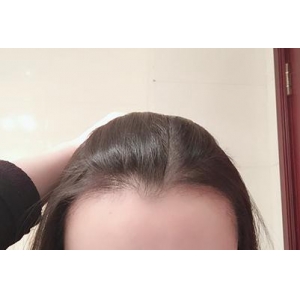 杭州时光医疗美容医院发际线种植技术怎么样？王洁院长亲诊案例与价格全解析