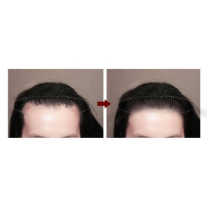 长沙美人尖种植哪家医院技术强？这五家植发机构口碑与实力并存