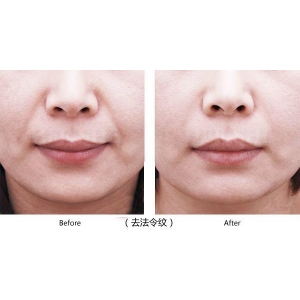 福州格莱美美容医院轮廓塑形效果好吗？玻尿酸填充真实案例分享