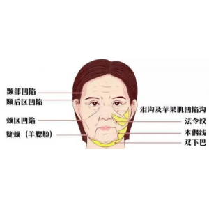 三亚福音妇产医院玻尿酸祛法令纹技术怎么样？真人案例与价格全解析
