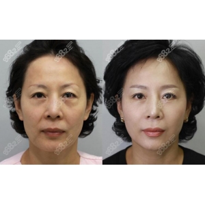 重庆刘正茂医生怎么样？磨骨技术精湛，风格自然堪称典范