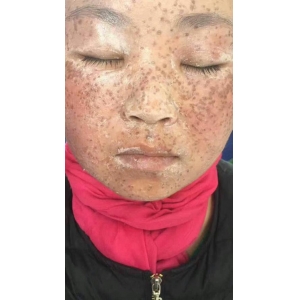 深圳祛斑医院哪家专业？五家实力机构深度解析，附价格参考