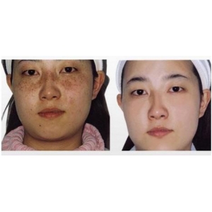 北京祛斑哪家医院值得选？润美玉之光专业祛斑15年口碑有保障