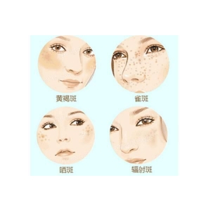 厦门欧菲医疗美容医院祛斑技术怎么样？资深医师激光祛斑案例实录